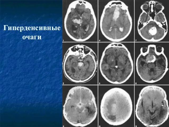 Гиперденсивные очаги