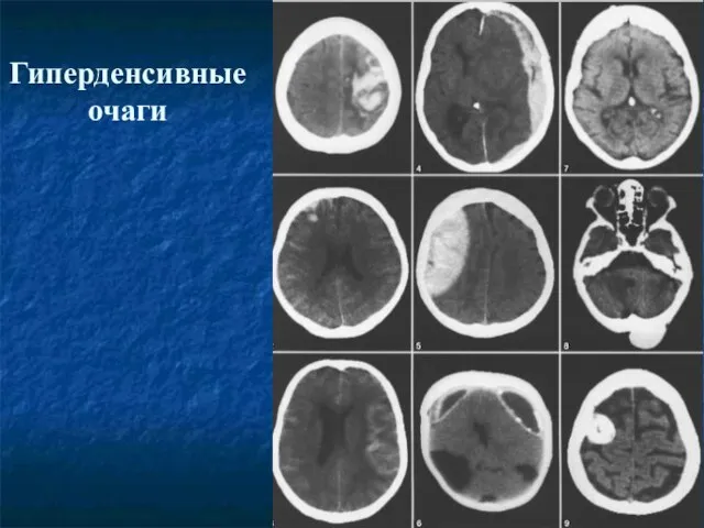 Гиперденсивные очаги