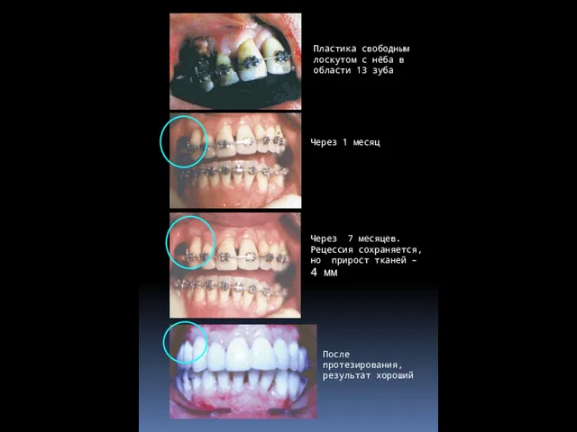 После протезирования, результат хороший