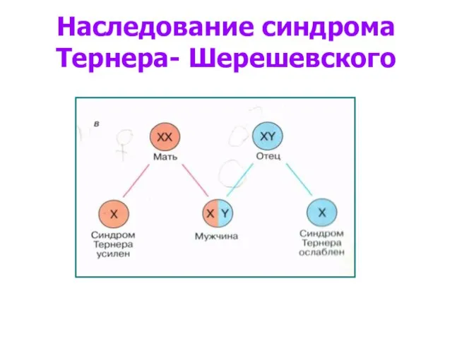 Наследование синдрома Тернера- Шерешевского