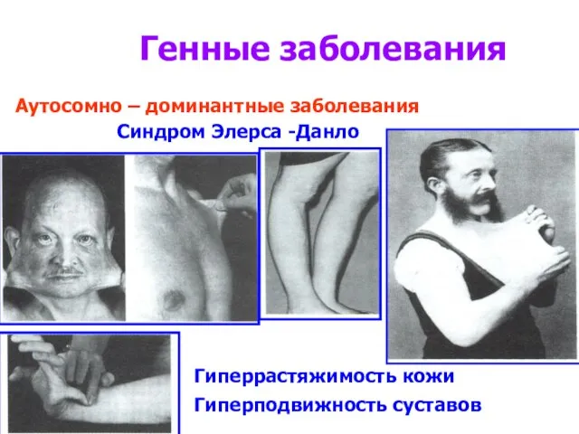 Генные заболевания Синдром Элерса -Данло Аутосомно – доминантные заболевания Гиперрастяжимость кожи Гиперподвижность суставов