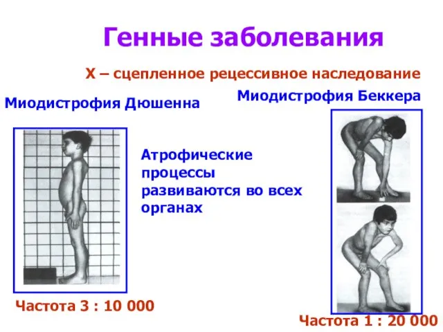 Генные заболевания Х – сцепленное рецессивное наследование Миодистрофия Дюшенна Частота 3