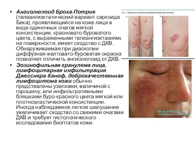 Ангиолюпоид Брока-Потрие (телеангиэктатический вариант саркоида Бека), проявляющийся на коже лица в