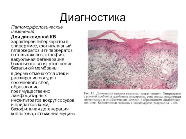 Диагностика Патоморфологические изменения Для дискоидной КВ характерен гиперкератоз в эпидермисе, фоликулярный