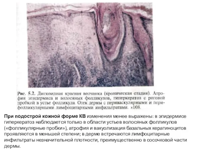 При подострой кожной форме КВ изменения менее выражены: в эпидермисе гиперкератоз