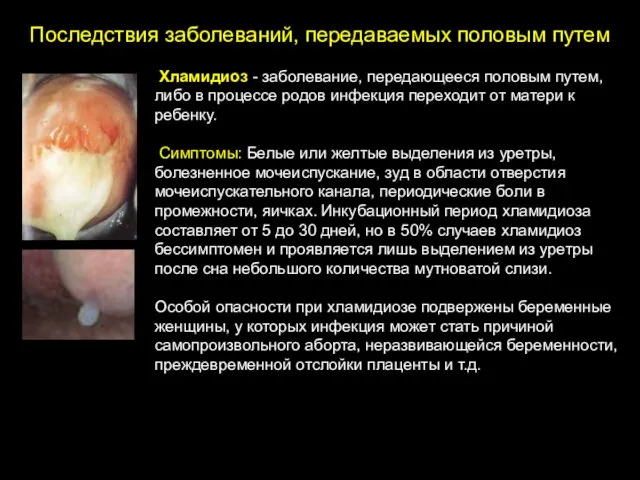 Последствия заболеваний, передаваемых половым путем Хламидиоз - заболевание, передающееся половым путем,