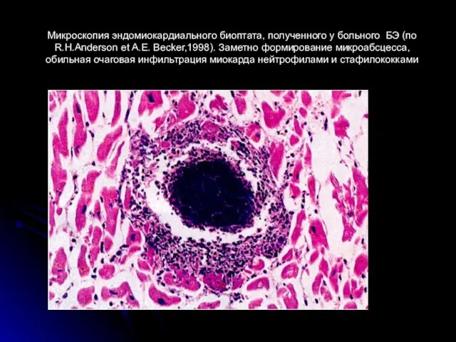 Микроскопия эндомиокардиального биоптата, полученного у больного БЭ (по R.H.Anderson et A.E.