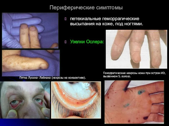 Периферические симптомы петехиальные геморрагические высыпания на коже, под ногтями. Узелки Ослера: