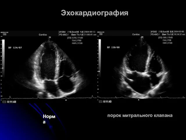 Эхокардиография порок митрального клапана Норма