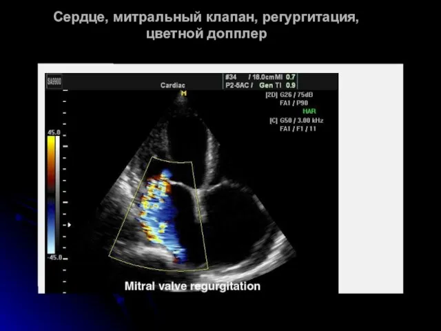 Сердце, митральный клапан, регургитация, цветной допплер