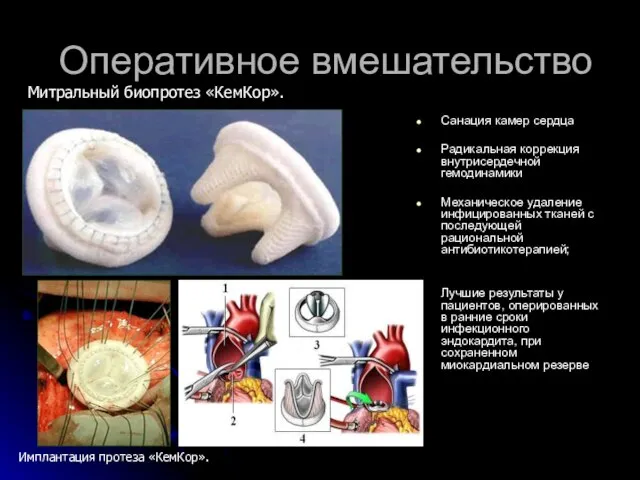 Оперативное вмешательство Санация камер сердца Радикальная коррекция внутрисердечной гемодинамики Механическое удаление