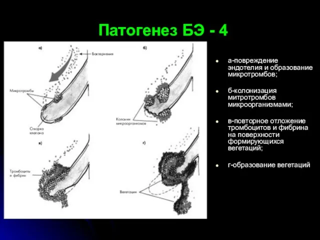 Патогенез БЭ - 4 а-повреждение эндотелия и образование микротромбов; б-колонизация митротромбов
