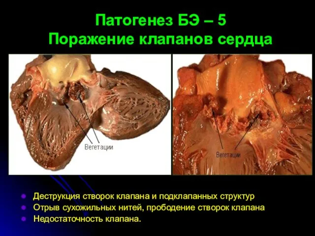 Патогенез БЭ – 5 Поражение клапанов сердца Деструкция створок клапана и