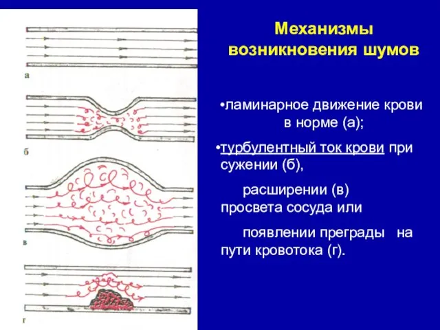 Механизмы возникновения шумов ламинарное движение крови в норме (а); турбулентный ток