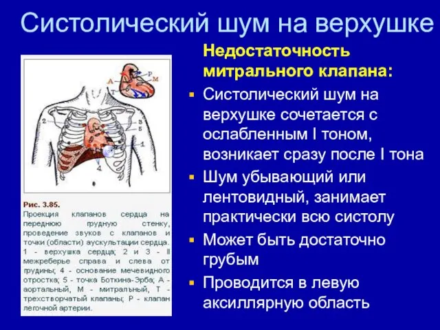 Систолический шум на верхушке Недостаточность митрального клапана: Систолический шум на верхушке