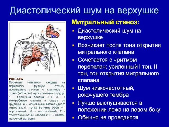 Диастолический шум на верхушке Митральный стеноз: Диастолический шум на верхушке Возникает