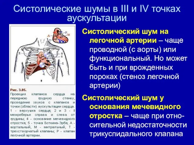 Систолические шумы в III и IV точках аускультации Систолический шум на