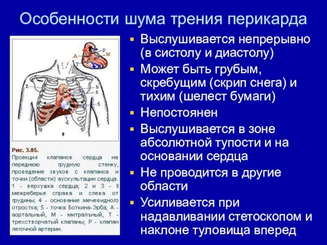 Особенности шума трения перикарда Выслушивается непрерывно (в систолу и диастолу) Может