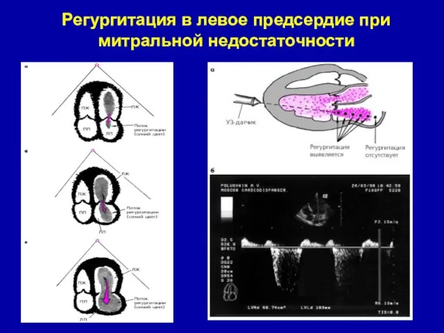 Регургитация в левое предсердие при митральной недостаточности