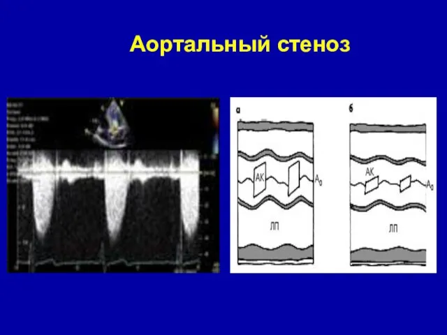 Аортальный стеноз