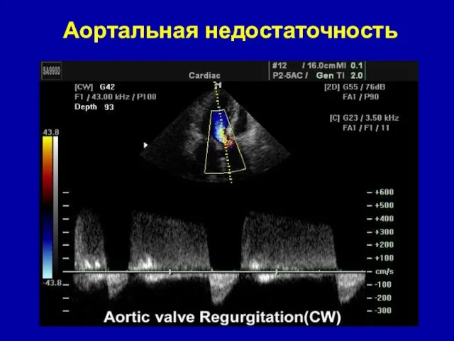 Аортальная недостаточность