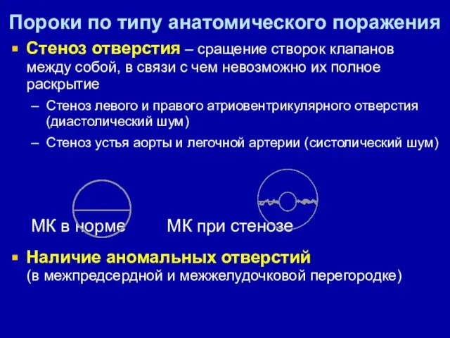 Пороки по типу анатомического поражения Стеноз отверстия – сращение створок клапанов