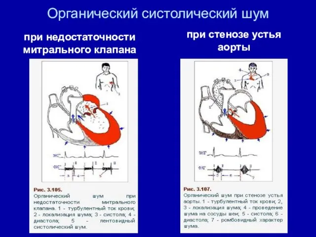 Органический систолический шум при стенозе устья аорты при недостаточности митрального клапана