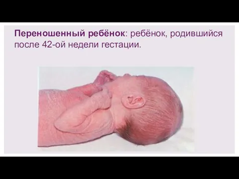 Переношенный ребёнок: ребёнок, родившийся после 42-ой недели гестации.