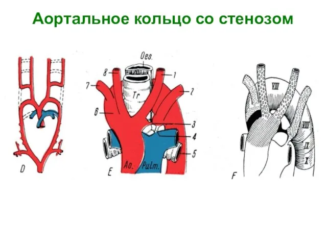 Аортальное кольцо со стенозом