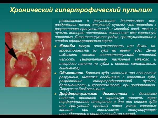 Хронический гипертрофический пульпит развивается в результате длительного мех. раздражения ткани открытой