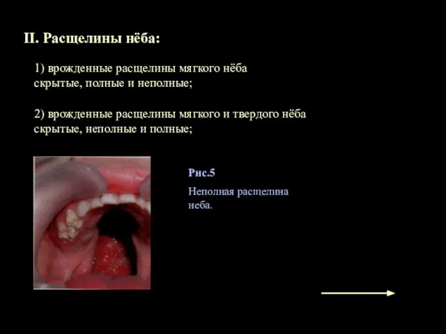 II. Расщелины нёба: 1) врожденные расщелины мягкого нёба скрытые, полные и