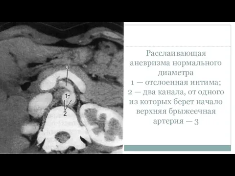 Расслаивающая аневризма нормального диаметра 1 — отслоенная интима; 2 — два