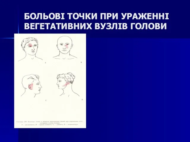 БОЛЬОВІ ТОЧКИ ПРИ УРАЖЕННІ ВЕГЕТАТИВНИХ ВУЗЛІВ ГОЛОВИ