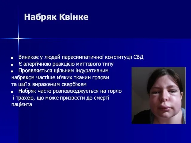 Набряк Квінке Виникає у людей парасимпатичної конституції СВД Є алергічною реакцією