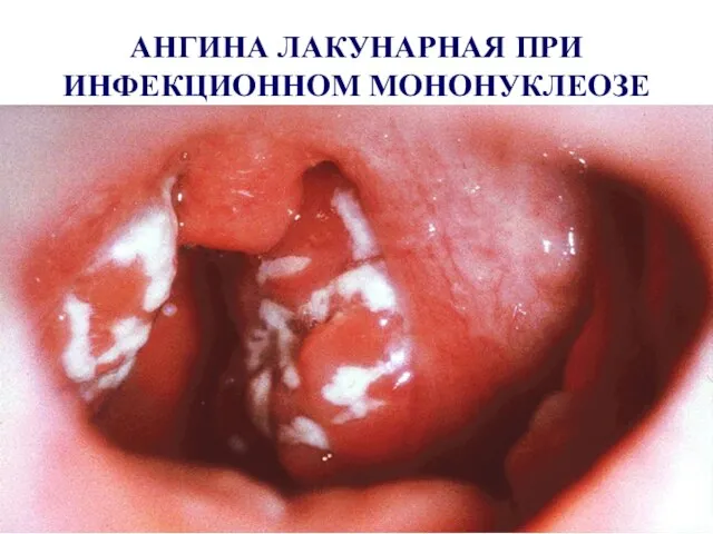 АНГИНА ЛАКУНАРНАЯ ПРИ ИНФЕКЦИОННОМ МОНОНУКЛЕОЗЕ