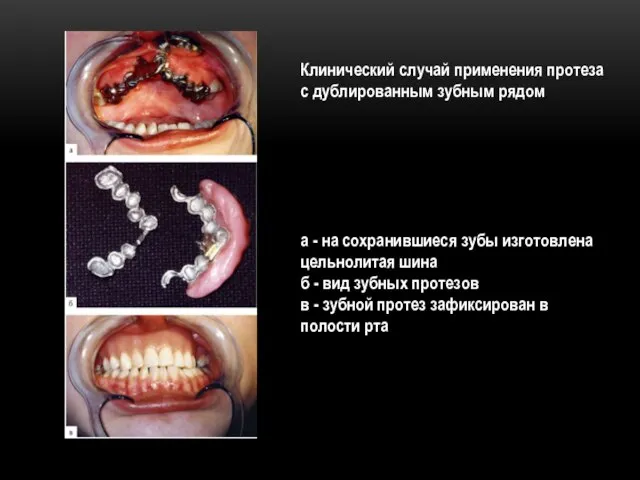 Клинический случай применения протеза с дублированным зубным рядом а - на