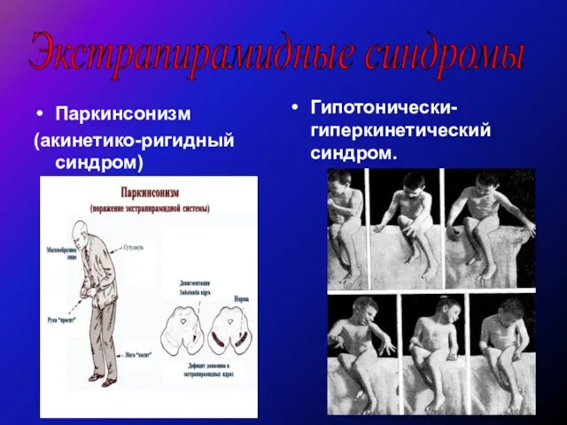 Экстрапирамидные синдромы Паркинсонизм (акинетико-ригидный синдром) Гипотонически-гиперкинетический синдром.