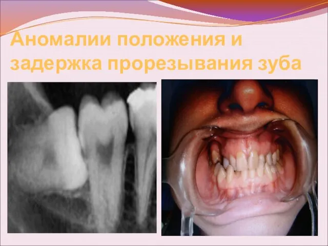 Аномалии положения и задержка прорезывания зуба