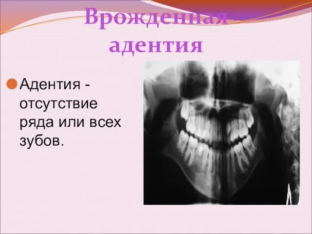 Врожденная адентия Адентия - отсутствие ряда или всех зубов.