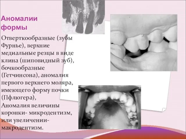 Аномалии формы Отверткообразные (зубы Фурнье), верхние медиальные резцы в виде клина