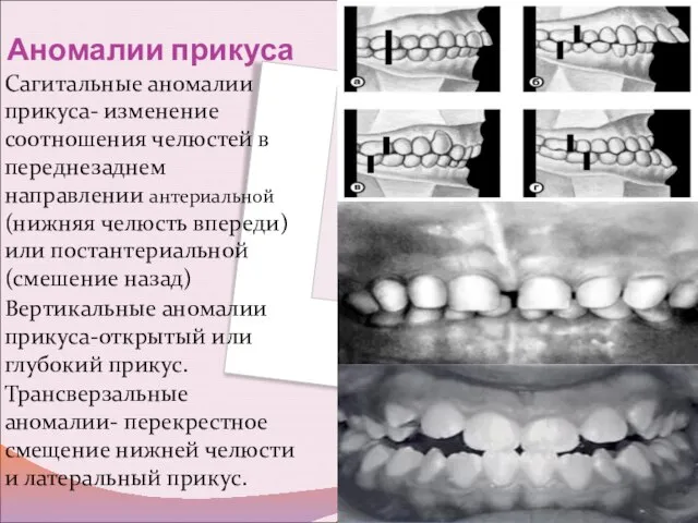 Аномалии прикуса Сагитальные аномалии прикуса- изменение соотношения челюстей в переднезаднем направлении