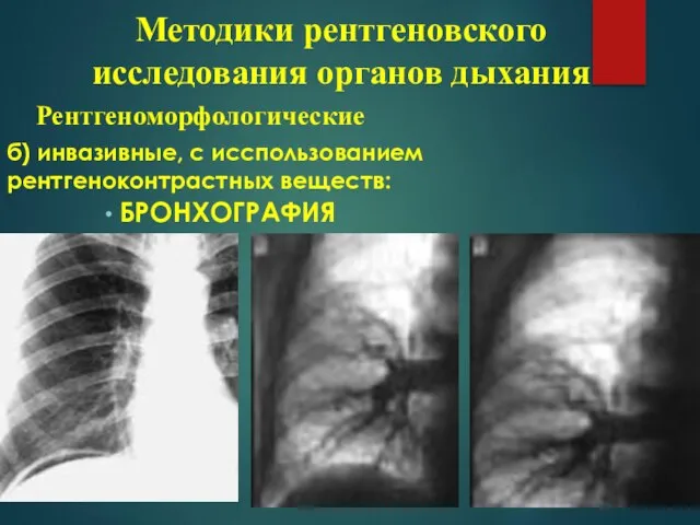 б) инвазивные, с исспользованием рентгеноконтрастных веществ: БРОНХОГРАФИЯ Методики рентгеновского исследования органов дыхания Рентгеноморфологические