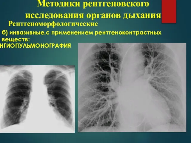 б) инвазивные,с применением рентгеноконтрастных веществ: АНГИОПУЛЬМОНОГРАФИЯ Методики рентгеновского исследования органов дыхания Рентгеноморфологические