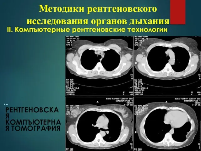 ІІ. Компъютерные рентгеновские технологии -РЕНТГЕНОВСКАЯ КОМПЪЮТЕРНАЯ ТОМОГРАФИЯ Методики рентгеновского исследования органов дыхания