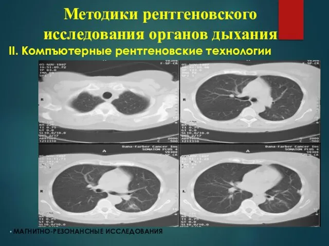 ІІ. Компъютерные рентгеновские технологии МАГНИТНО-РЕЗОНАНСНЫЕ ИССЛЕДОВАНИЯ Методики рентгеновского исследования органов дыхания