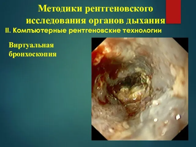 ІІ. Компъютерные рентгеновские технологии Методики рентгеновского исследования органов дыхания Виртуальная бронхоскопия