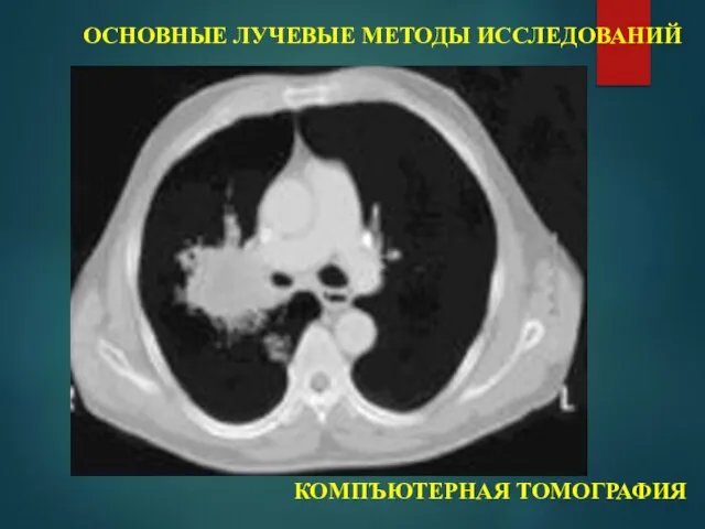 ОСНОВНЫЕ ЛУЧЕВЫЕ МЕТОДЫ ИССЛЕДОВАНИЙ КОМПЪЮТЕРНАЯ ТОМОГРАФИЯ