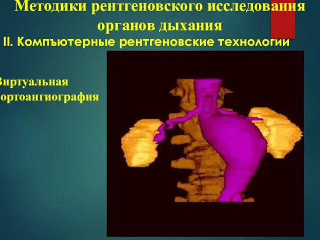 ІІ. Компъютерные рентгеновские технологии Методики рентгеновского исследования органов дыхания Виртуальная аортоангиография