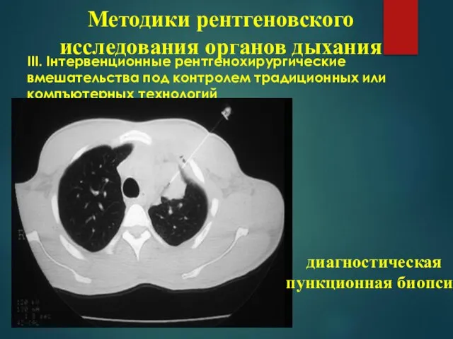 ІІІ. Інтервенционные рентгенохирургические вмешательства под контролем традиционных или компъютерных технологий Методики