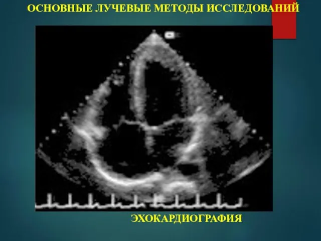 ОСНОВНЫЕ ЛУЧЕВЫЕ МЕТОДЫ ИССЛЕДОВАНИЙ ЭХОКАРДИОГРАФИЯ